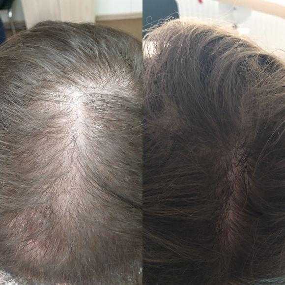Ковид волосы выпадают что делать. Диффузное выпадение волос. Выпадение волос до и после. Выпадение волос анемия.
