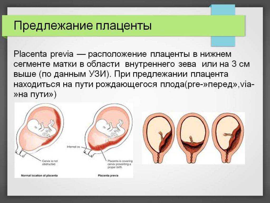 Фото низкая плацентация