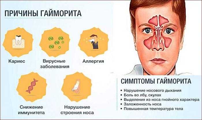 Где болит при гайморите фото