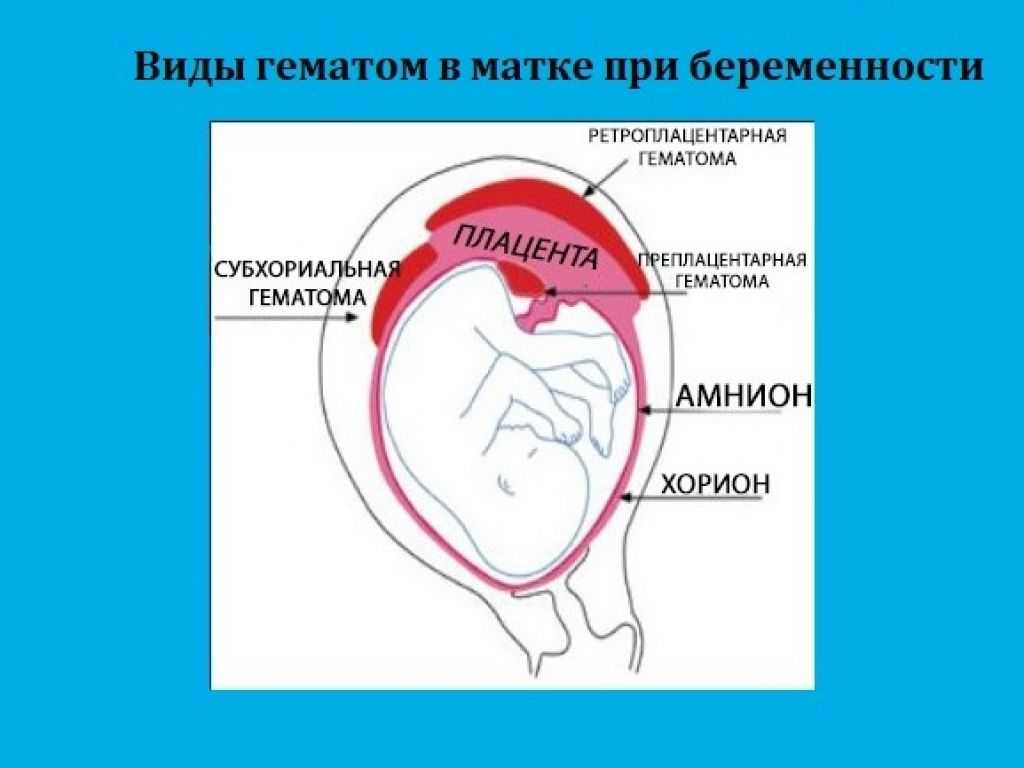 Отслойка 8 недель. Гематома в матке при беременности 12 недель. Отслойка хориона с ретрохориальной гематомой. Ретрохориональная гематома. Retroxorional gematoma.