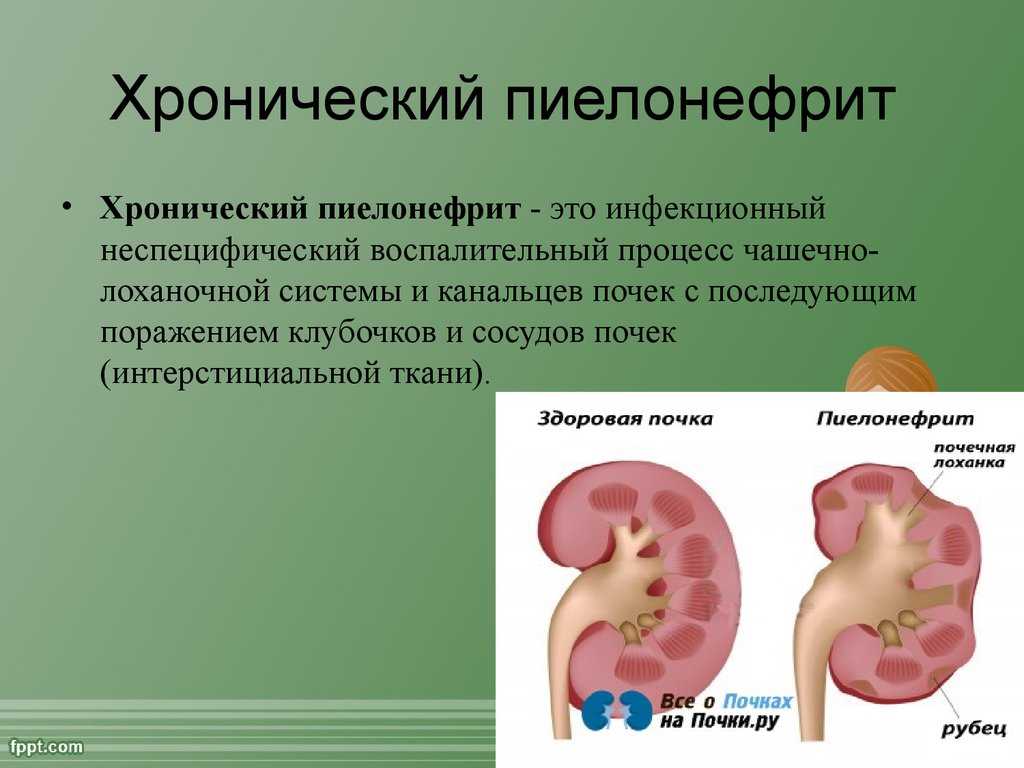 Карта острый пиелонефрит