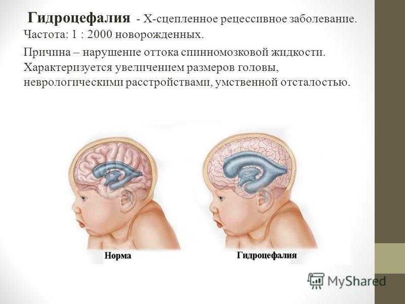 Как лечить гидроцефалию мозга. Гидроцефалия у новорожденных. Гидроцефалия головного мозга у ребенка. Гидроцефалия головного мозга у взрослого.