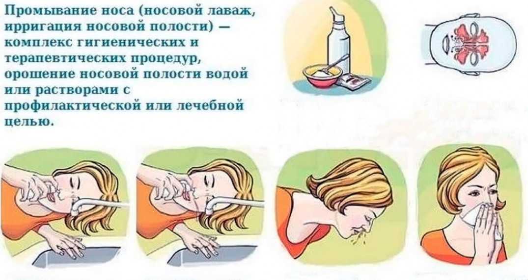 При промывании носа вода не вытекает. Промывание носа. Промывать нос. Схема промывания носа. Промывание носа солевым раствором шприцом.