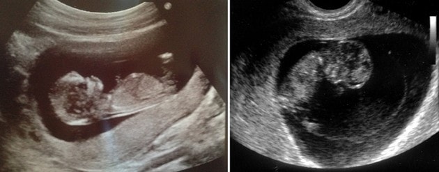 Десятка недели. 10 Недель беременности фото плода на УЗИ. УЗИ плода на 10 неделе беременности. УЗИ 10 недель беременности. Эмбрион на 10 неделе беременности УЗИ.