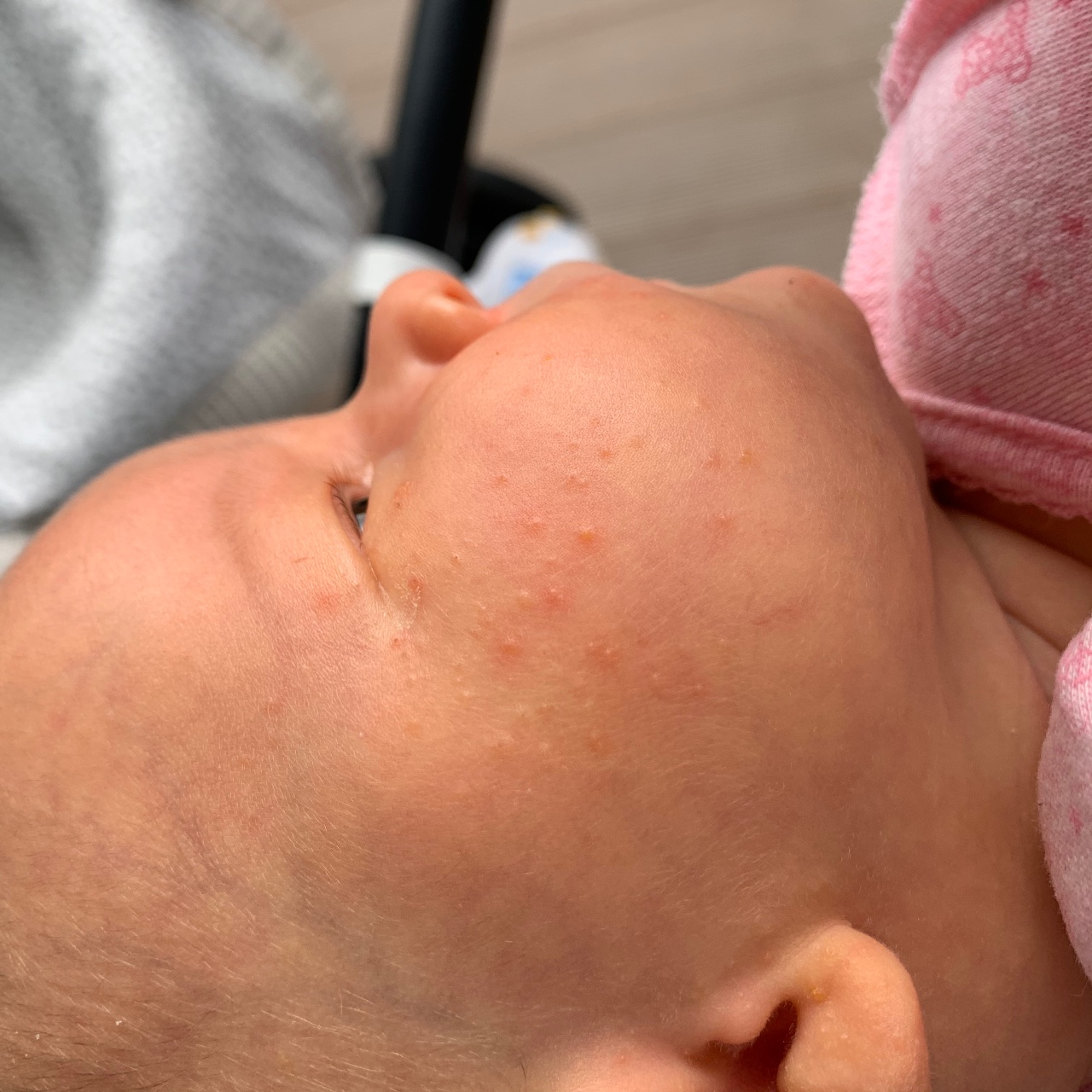 Как распознать аллергию у грудничков на лице: Эффективные методы лечения и профилактики