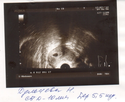 Фото узи на 5 неделе. УЗИ 5 5 недель беременности. Снимок УЗИ беременности 4-5 недель. УЗИ 5 акушерских недель 2 дня беременности двойня. Снимок УЗИ на 5 неделе беременности.