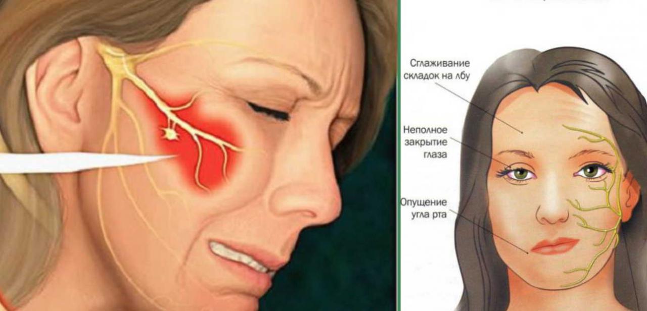 Ощущение что опухли. Лицевой нерв и тройничный нерв. Воспаление тройничного лицевого нерва симптомы. Неврит тройничного нерва симптомы. Прозопалгия левосторонняя прозопалгия.