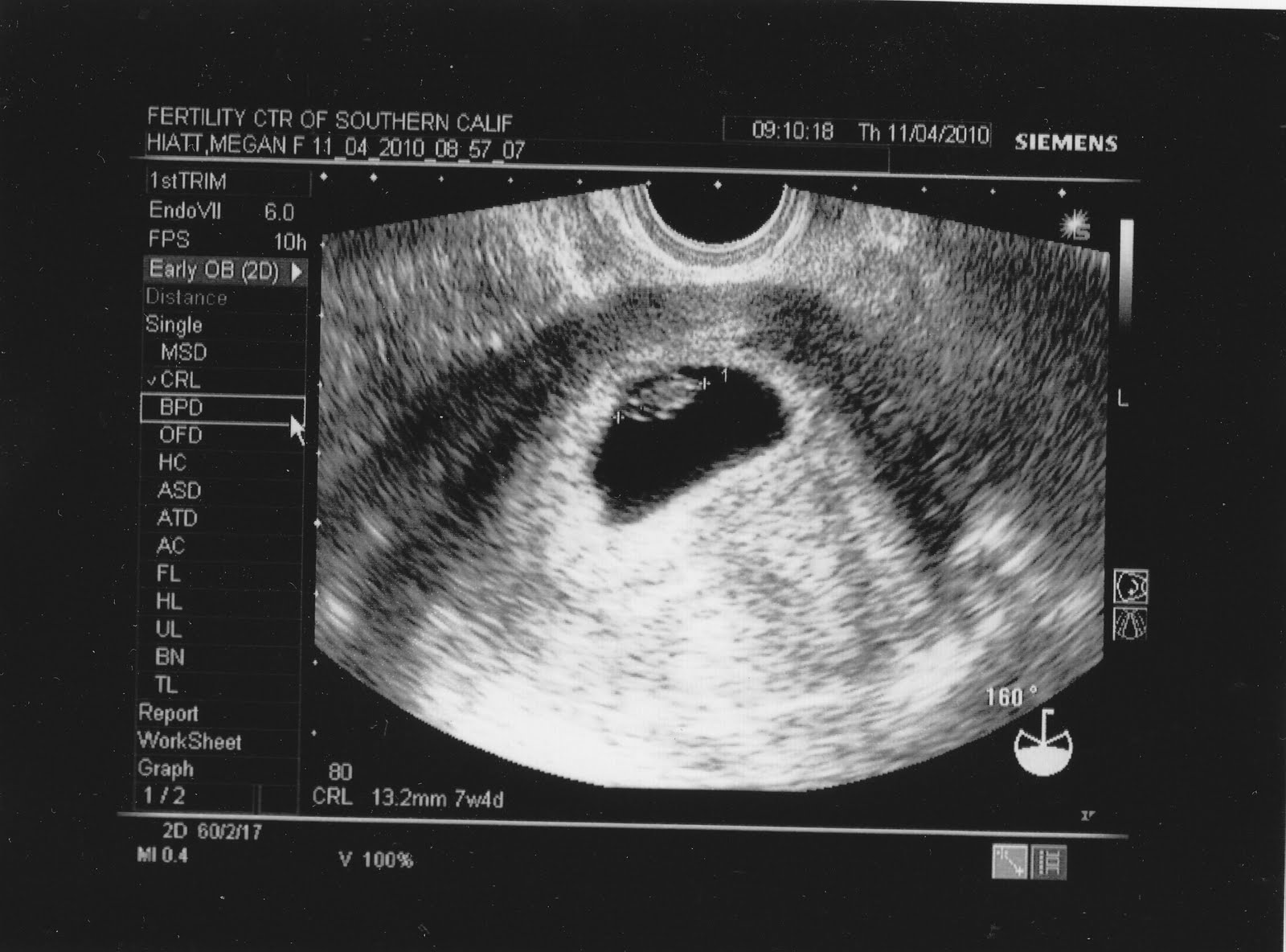 Узи эмбриона 7 недель