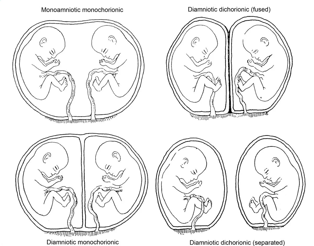 Виды близнецов схема