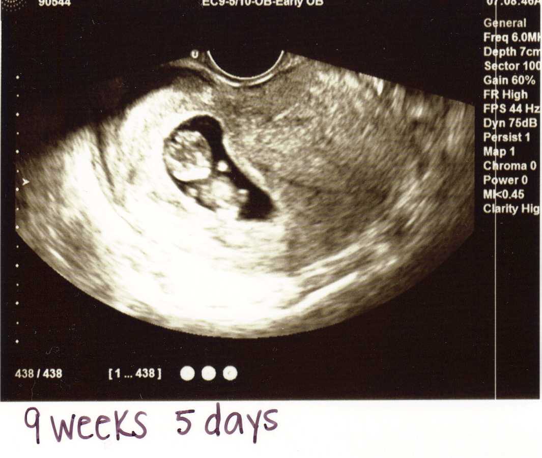 Конец 9 недели. Эмбрион на 8-9 неделе беременности УЗИ. Плод на 9 неделе беременности по УЗИ. Эмбрион на 9 акушерской неделе. УЗИ на 9 акушерской неделе беременности.