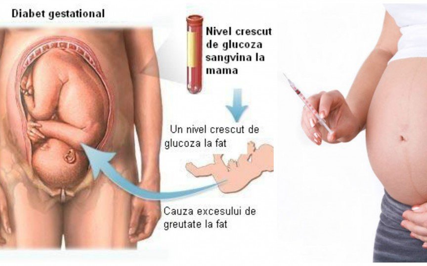 Bote glucosa embarazo