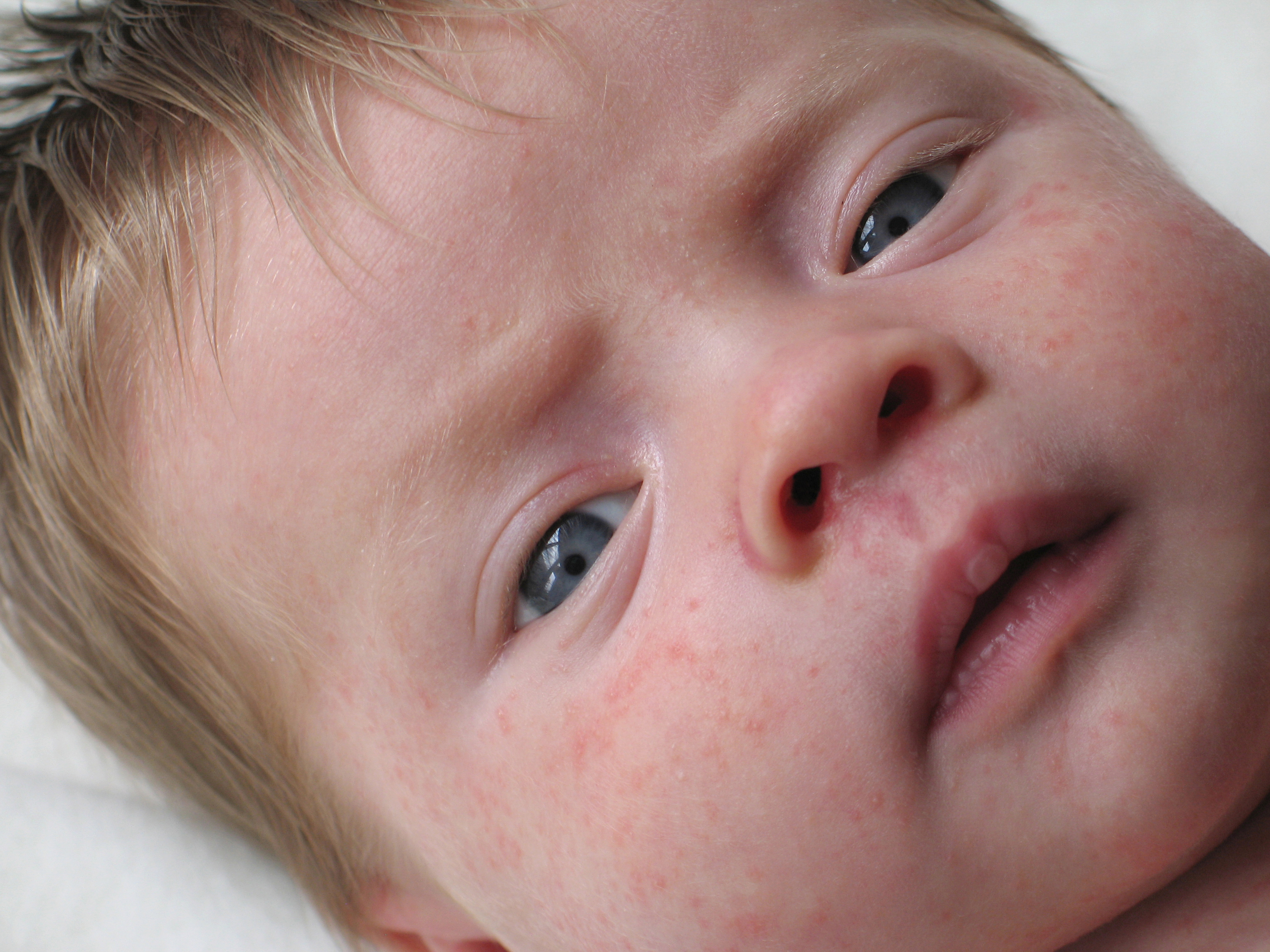 Реакция ребенка на другого ребенка. Атопический дерматит на лице у грудничка. Дескваматозный дерматит.