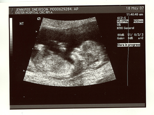 Узи плода 12 недель беременности. УЗИ 12 недель беременности. Фотографии УЗИ беременности 12 недель. Снимок УЗИ на 12 неделе беременности. УЗИ 12 недель беременности мальчик.