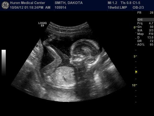 18 недель мальчик. УЗИ 17-18 недель беременности. УЗИ на 18 неделе беременности пол ребенка. 18 Недель беременности фото УЗИ пол ребенка.