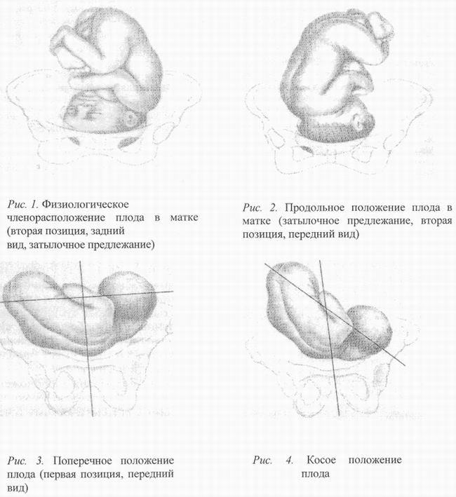 Косое и поперечное положение плода презентация