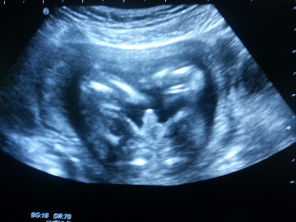 Фото узи 22 недели беременности мальчик