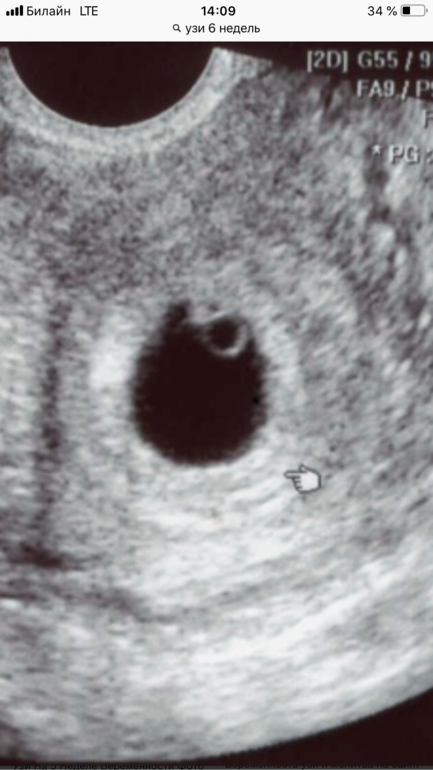 7 неделя беременности плодное яйцо. УЗИ анэмбриония 5 недель. Анэмбриония на УЗИ 6 недель. УЗИ анэмбриония 7 недель. Анэмбриония 7 недель беременности.