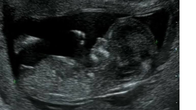 Сказали пол на первом скрининге. УЗИ 12 недель беременности пол. УЗИ мальчик 1 скрининг. УЗИ 12 недель скрининг мальчик.