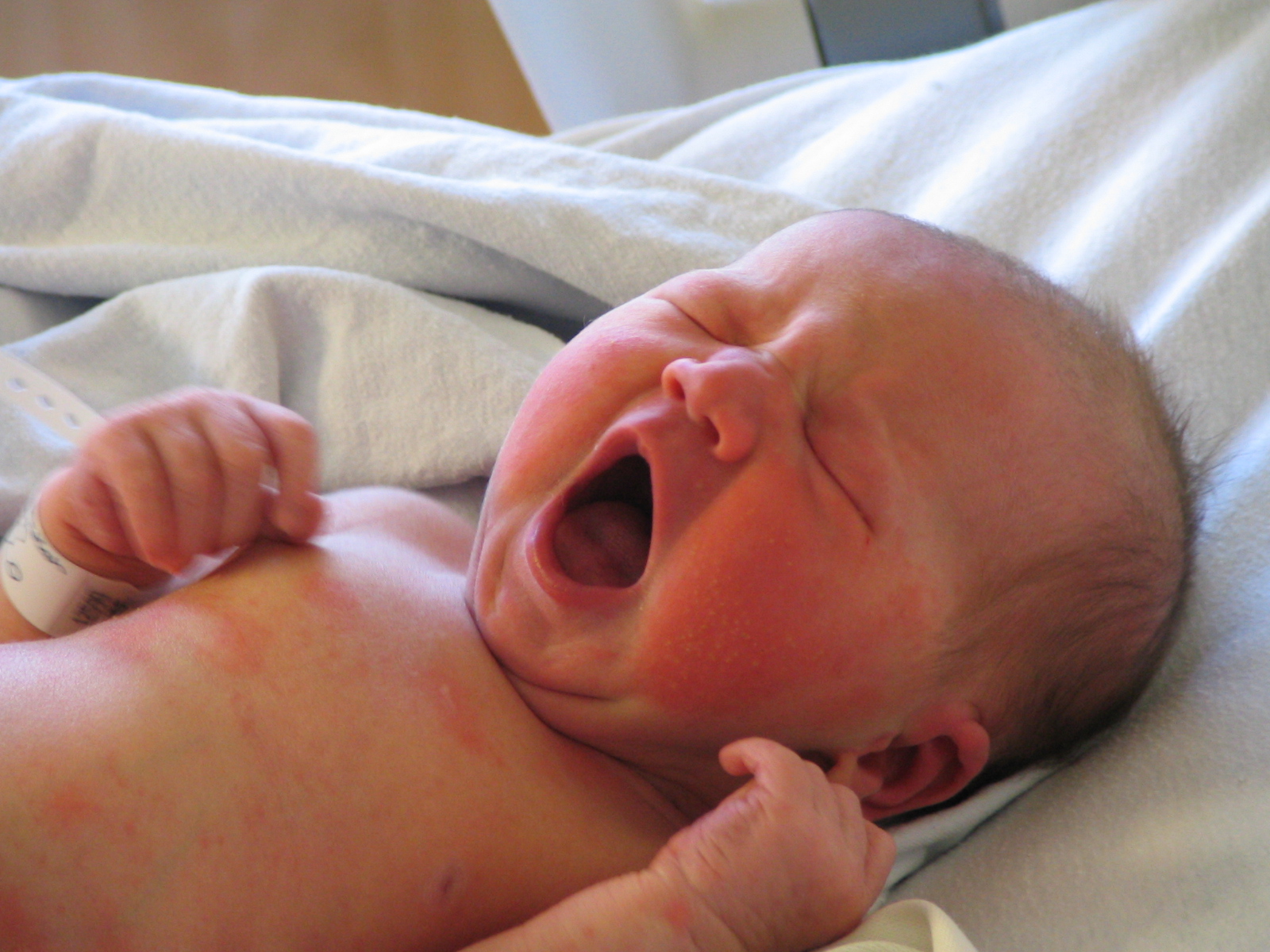 Токсическая эритема новорожденных