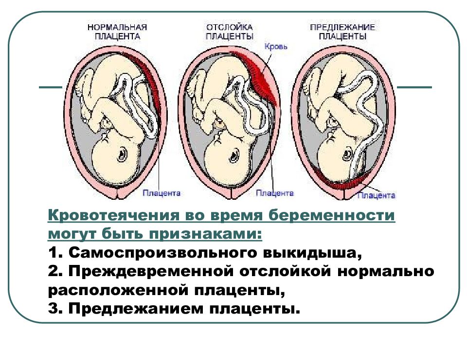 Патологическое прикрепление плаценты предлежание и врастание плаценты. Ретроплацентарная отслойка плаценты. Предлежание плаценты при беременности 24 недели. Отслойка плаценты на 24 неделе беременности симптомы. Отслойка плаценты при беременности в 1 триместре.