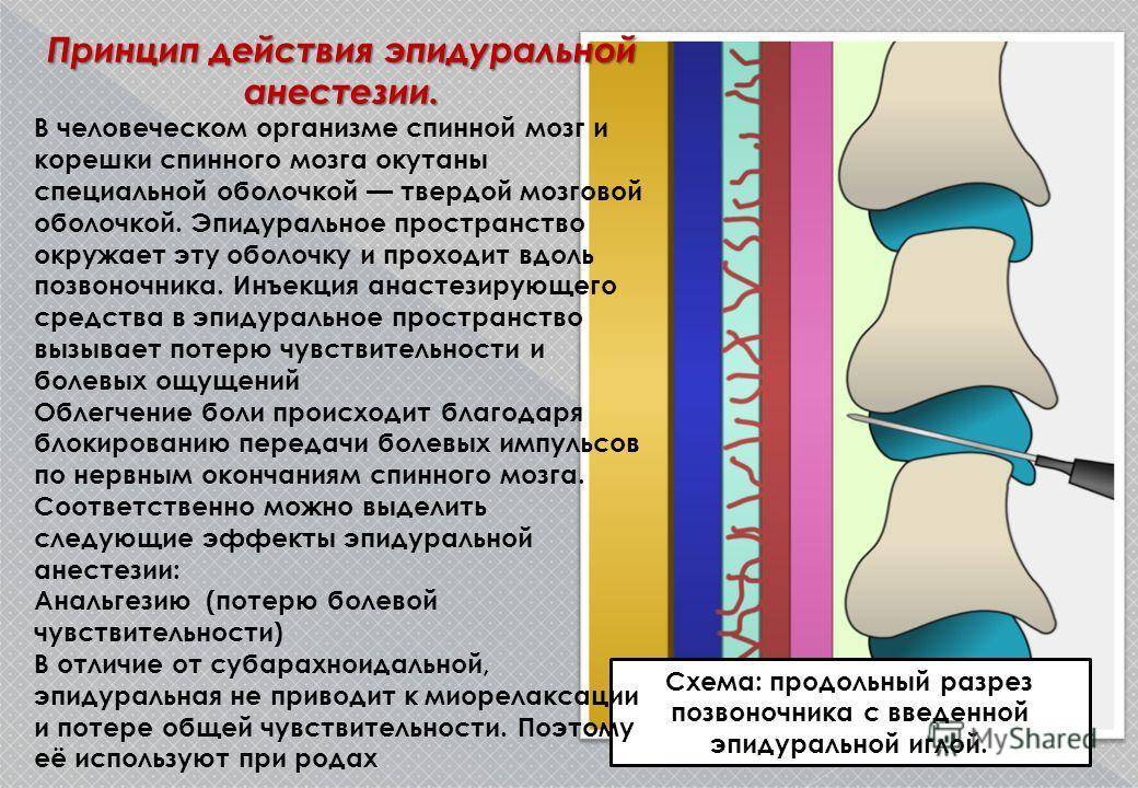 После спинномозгового наркоза. Эпидуральная анестезия. Спинальная и эпидуральная анестезия. Спинальная и эпидуральная анестезия отличия. Болит спина после эпидуральной анестезии.