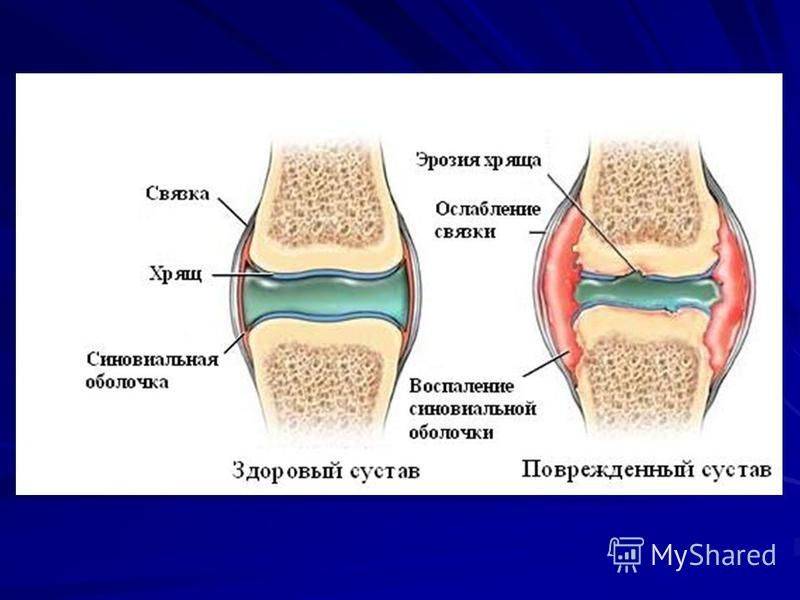 Артриты у детей презентация