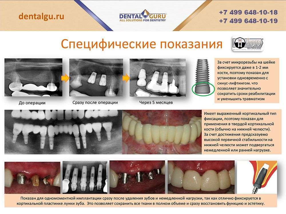 Схема имплантации зубов