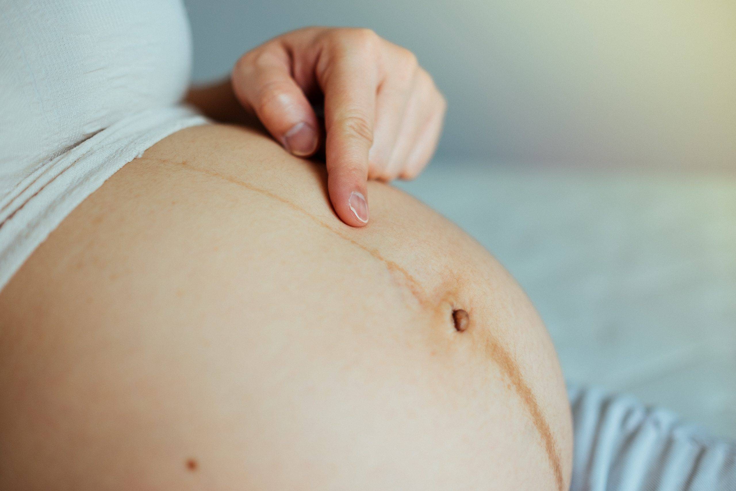 Как предотвратить растяжки вокруг пупка при беременности: Секреты красивого животика