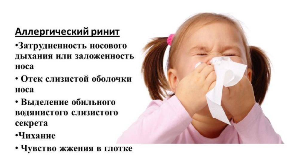 Кашель насморк 2 недели. Аллергический рахит у детей. Аллергический ринит симптомы у детей. Аллергический насморк у ребенка. Аллергический ринит проявления у детей.