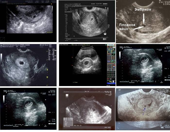 3 неделя мая. Как выглядит эмбрион в 3 недели на УЗИ. 2-3 Недели беременности симптомы. Симптомы беременности на 3 неделк.