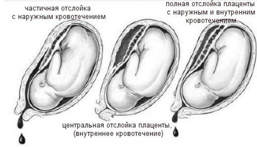 Отслойка плаценты на ранних сроках. Классификация отслойки плаценты. Полная преждевременная отслойка нормально расположенной плаценты. Преждевременная отслойка нормально расположенной плаценты картинки. Ретроплацентарная отслойка плаценты.