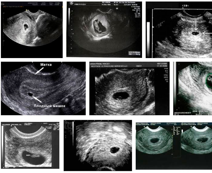 Не видно плодное яйцо на 5 неделе. Маточная беременность 5 недель УЗИ. Снимок УЗИ на 5 неделе беременности. Снимки УЗИ на 5 неделе беременности. УЗИ на 5 акушерской неделе беременности.
