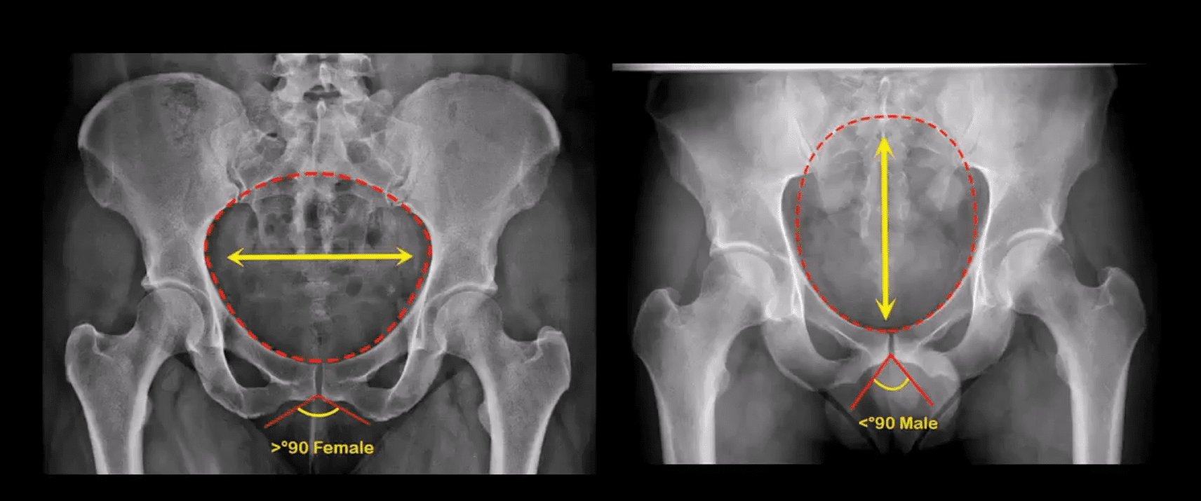 Расширение таза мужчин. Рентген костей таза у мужчин. Рентген таза и тазобедренных суставов мужчины. Тазобедренный сустав малый таз. Кости таза анатомия рентген.
