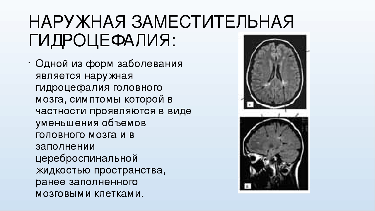 Операция гидроцефалия мозга. Наружная гидроцефалия головного мозга мрт. Заместительная наружная гидроцефалия кт. Гидроцефалия головного мозга на кт. Наружная и внутренняя гидроцефалия головного мозга.