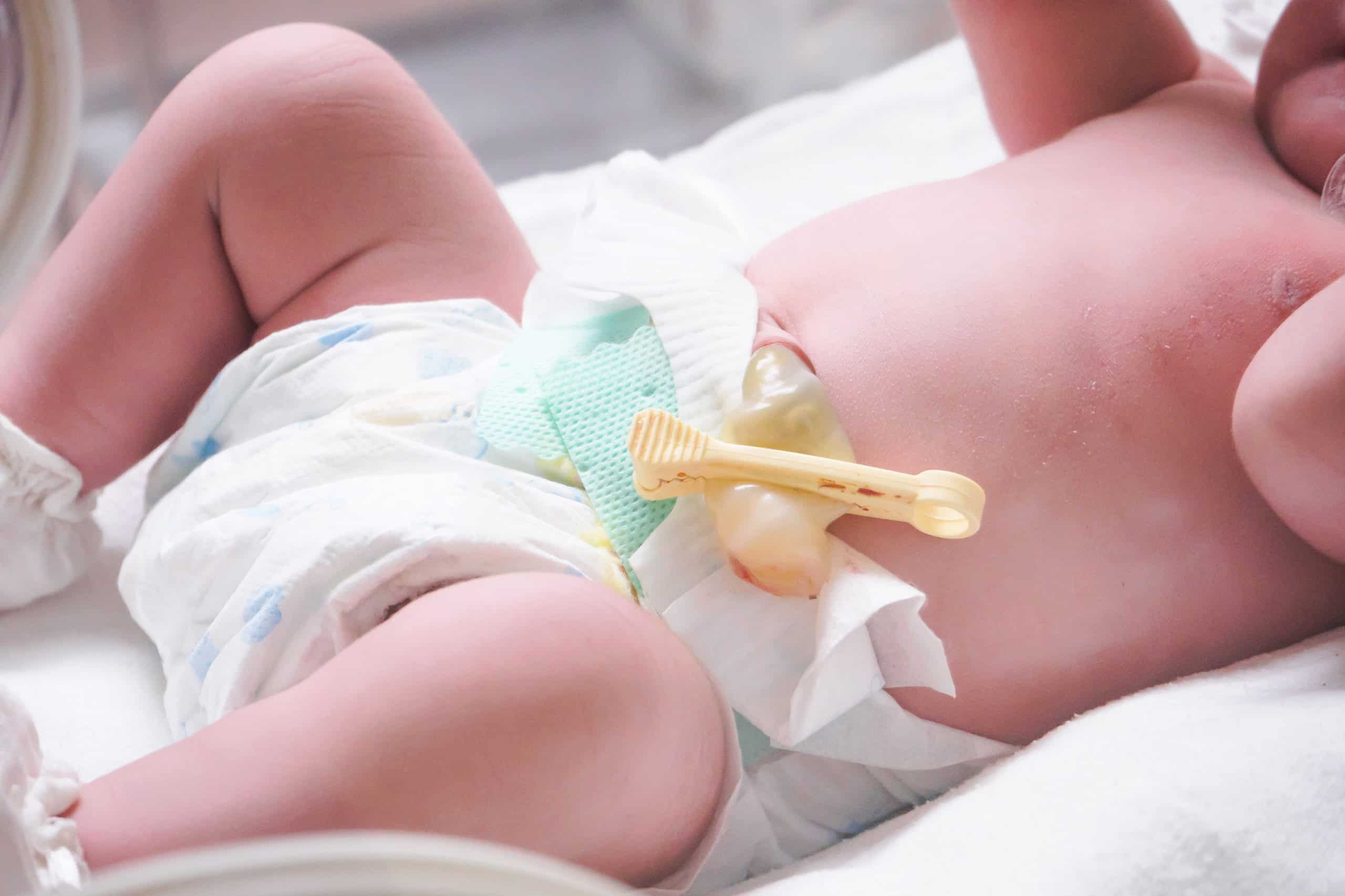 Как лечить мокнущий пупок у новорожденного: Советы заботливым родителям