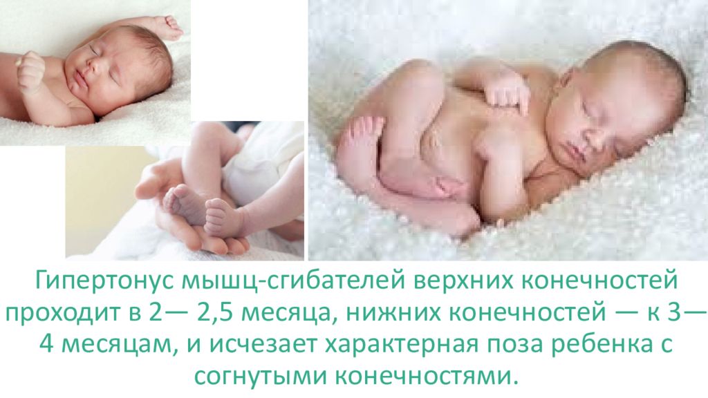 Тонус 6 месяцев. Гипертонус у ребенка 1 месяц. Физиологический гипертонус. Физиологический гипотонус. Гипертонус сгибателей.