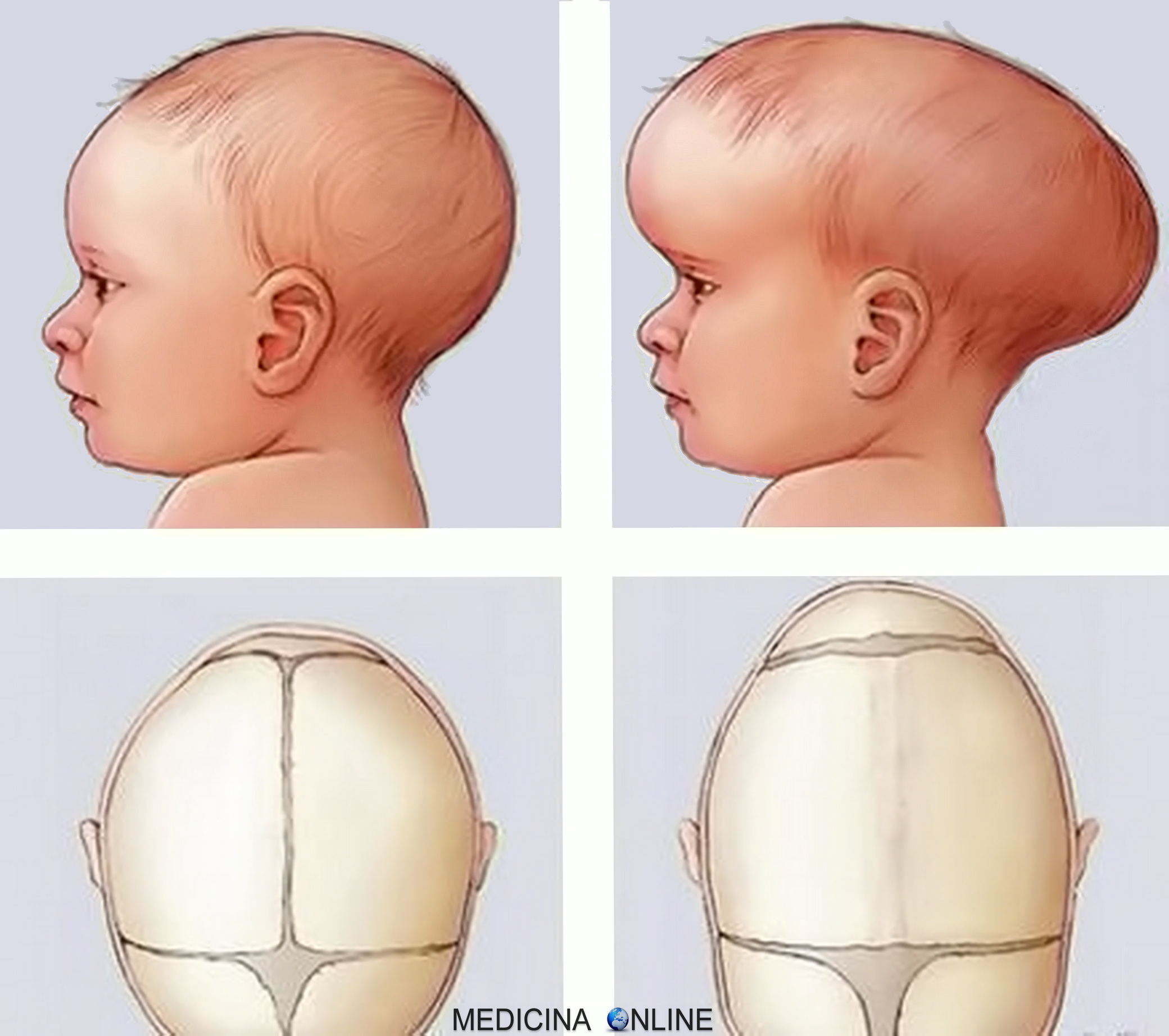 Долихоцефалическая форма головы у новорожденных