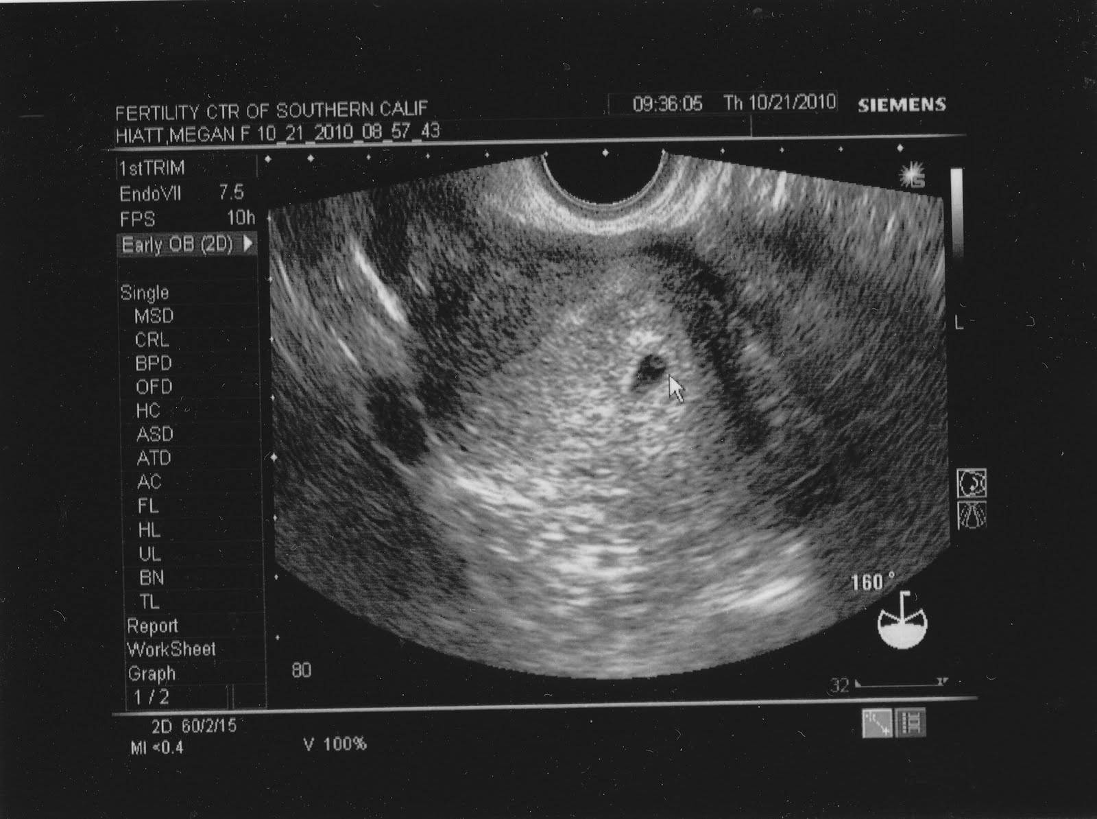 Как выглядит плод в 4 5 недель беременности фото