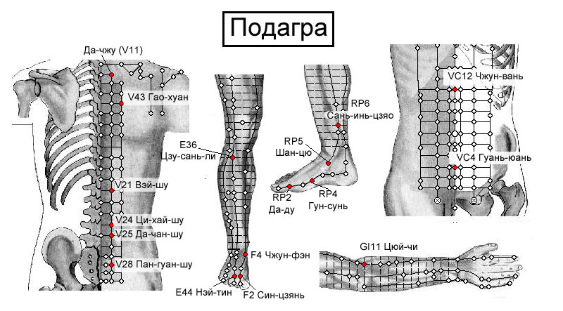 Точка помощи. Точки акупунктуры при подагре. Схема постановки пиявок при подагре. Схема постановки пиявок при подагре на ногах. Точки воздействия при подагре.