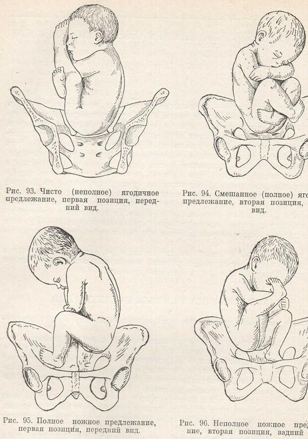 Виды предлежания. Предлежание плода позиции плода. Тазовое предлежание 1 позиция. Тазовое предлежание плода 1 позиция. Тазовое предлежание 2 позиция.