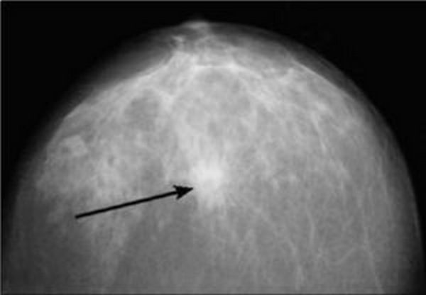 Фиброзные жировые изменения. Узловая мастопатия молочной железы маммография. Фибролипома молочной железы рентген. Фиброзная мастопатия маммограмма. Фиброаденома молочной железы маммограмма.