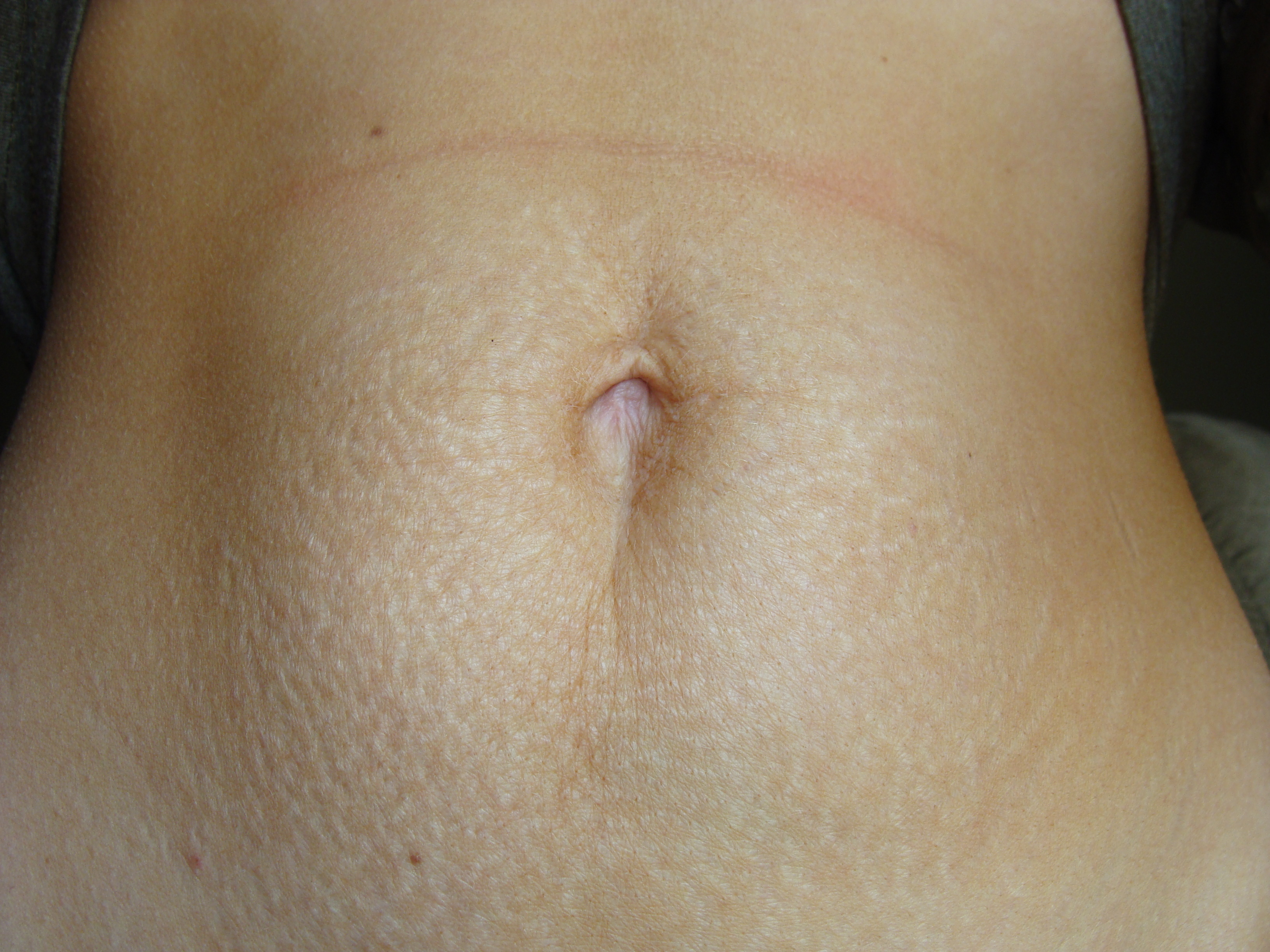 растяжки у женщин на груди фото 45