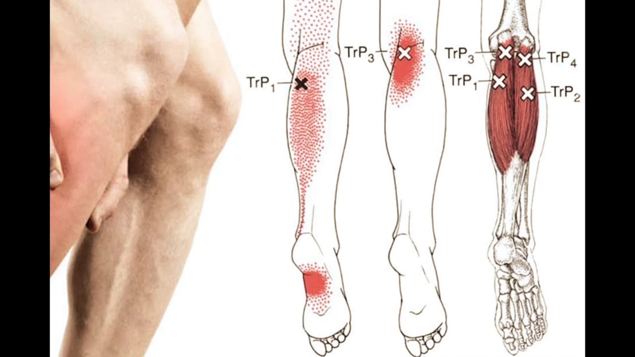 Боль в икрах ног причины у мужчин. Muller Weiss синдром на ноге.