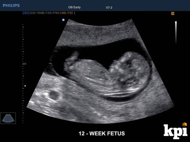 12 недель и 6 дней. Плод на 12 неделе беременности УЗИ. УЗИ на 12 акушерской неделе беременности. Снимки УЗИ беременности 12 недель. УЗИ плода 12 акушерских недель беременности.