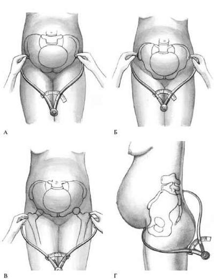 Расширение таза при беременности. Спинарум кристарум. Измерение наружных размеров таза пельвиометрия алгоритм. Измерения таза беременной в акушерстве. Расхождение тазовых костей при беременности.