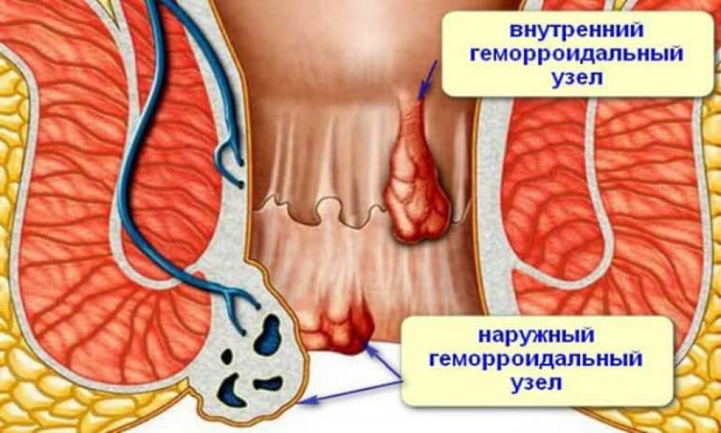 Внутренний узел. Тромбоз геморроя прямой кишки. Геморрой узел наружный тромбоз. Геморроидальные шишки. Наружныйгеморраидальный узел.