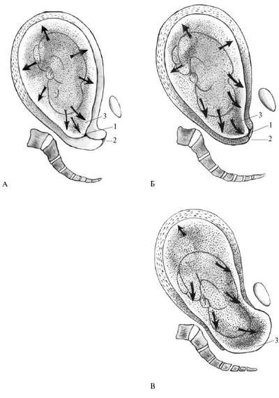 Роды рисунок схема. Раскрытие маточного зева в периоды родов. Образование плодного пузыря. Плоский плодный пузырь. Функция плодного пузыря в родах.