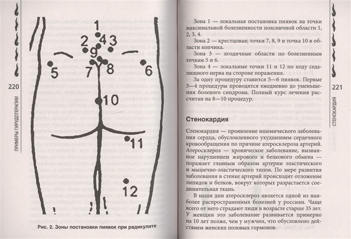 Точки для гирудотерапии картинки