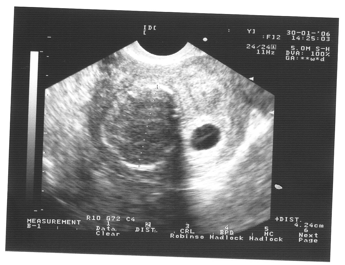 Матка 6 7 недель. УЗИ матки беременность 6 недель. Снимок УЗИ. Снимки УЗИ.