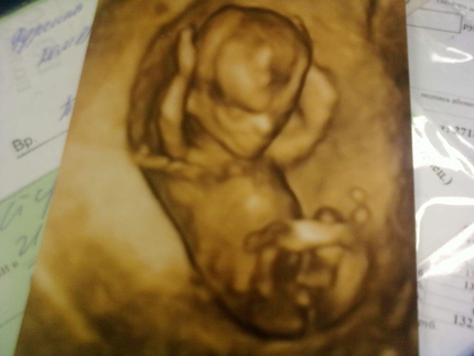 13 неделя коричневые. Ребёнок на 13 неделе беременности. УЗИ 13 недель беременности.